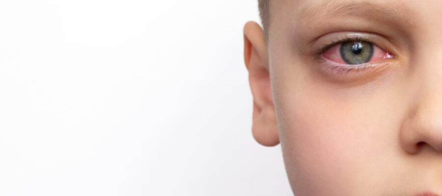 Conjuntivitis en niños: cómo reconocerla y tratarla de forma natural - Productos Bio Bio